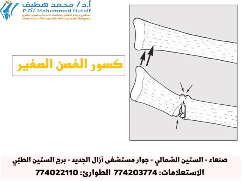 أنماط الكسور وأهميتها:كسور الغصن الصغير