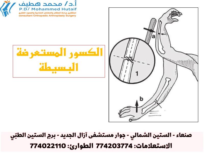 أنماط الكسور وأهميتها الكسور المستعرضة البسيطة