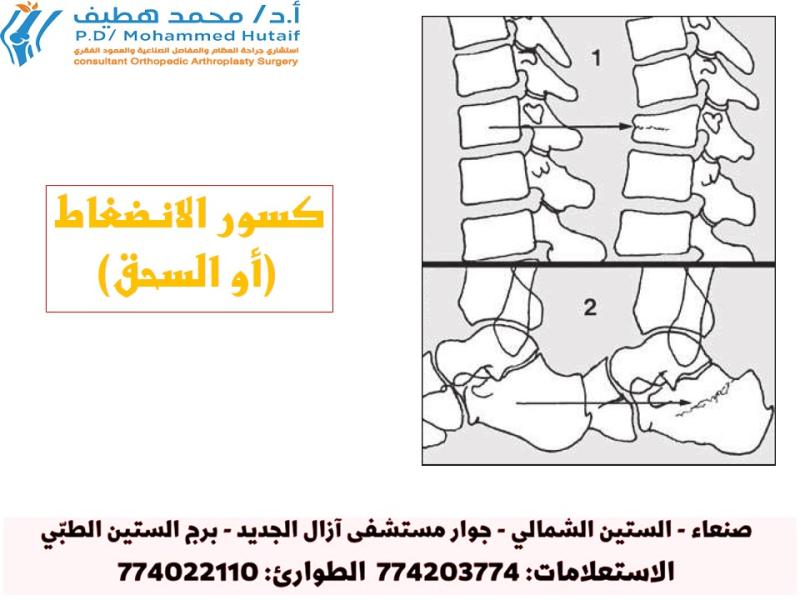 كسور الانضغاط (أو السحق): 