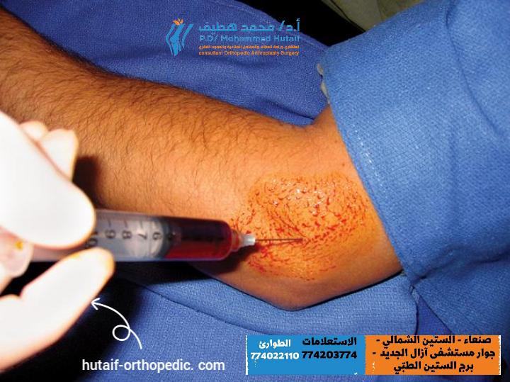 ما هو علاج التهاب مرفق التنس؟