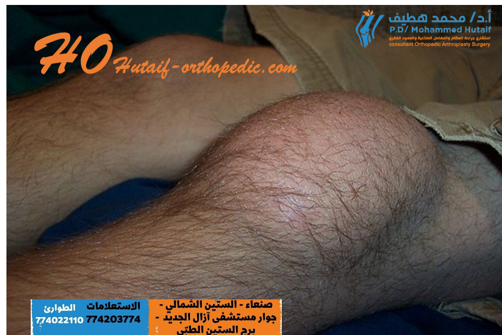 التهاب الجراب أو الالتهاب الكيسي في الركبة knee bursitis 