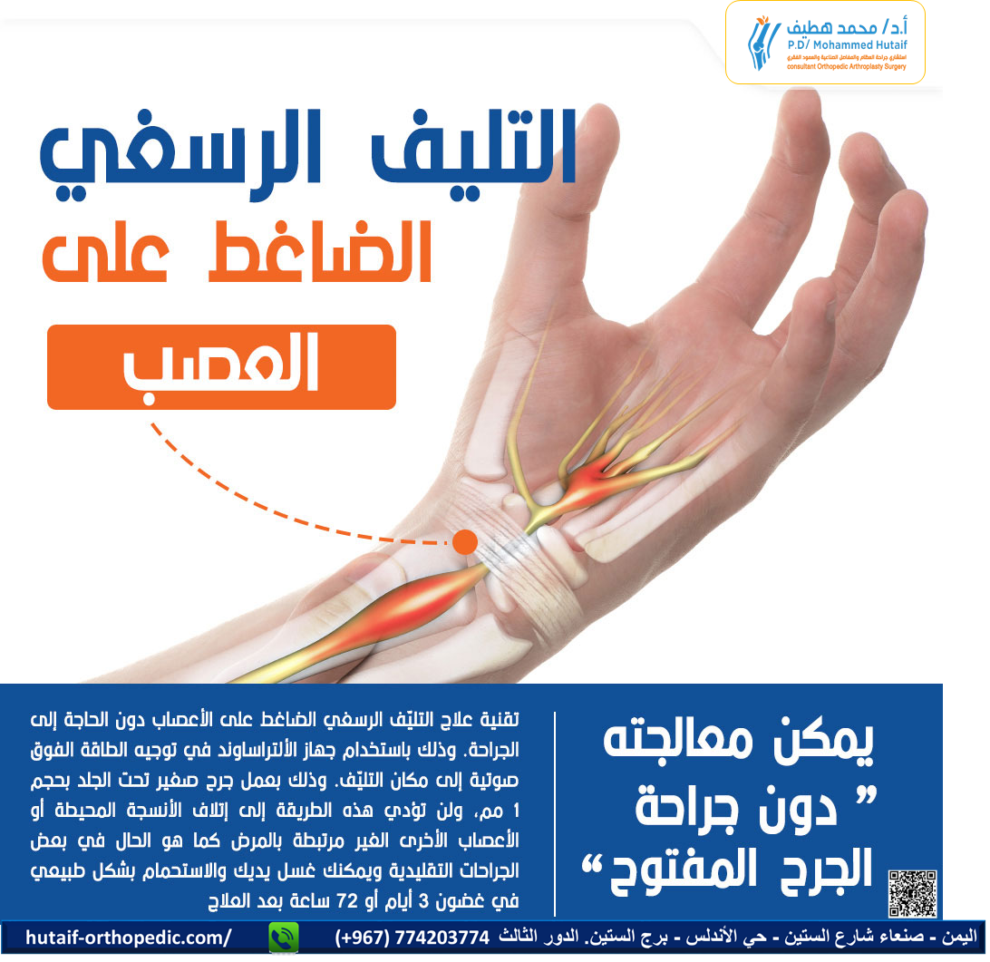 التليف الرسغي الضاغط على العصب يمكن معالجته دون جراحة