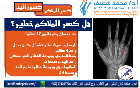 هل كسر الملاكم خطير؟