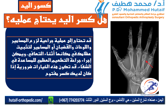 هل كسر اليد يحتاج عمليه؟