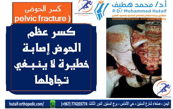كسر عظم الحوض إصابة خطيرة لا ينبغي تجاهلها