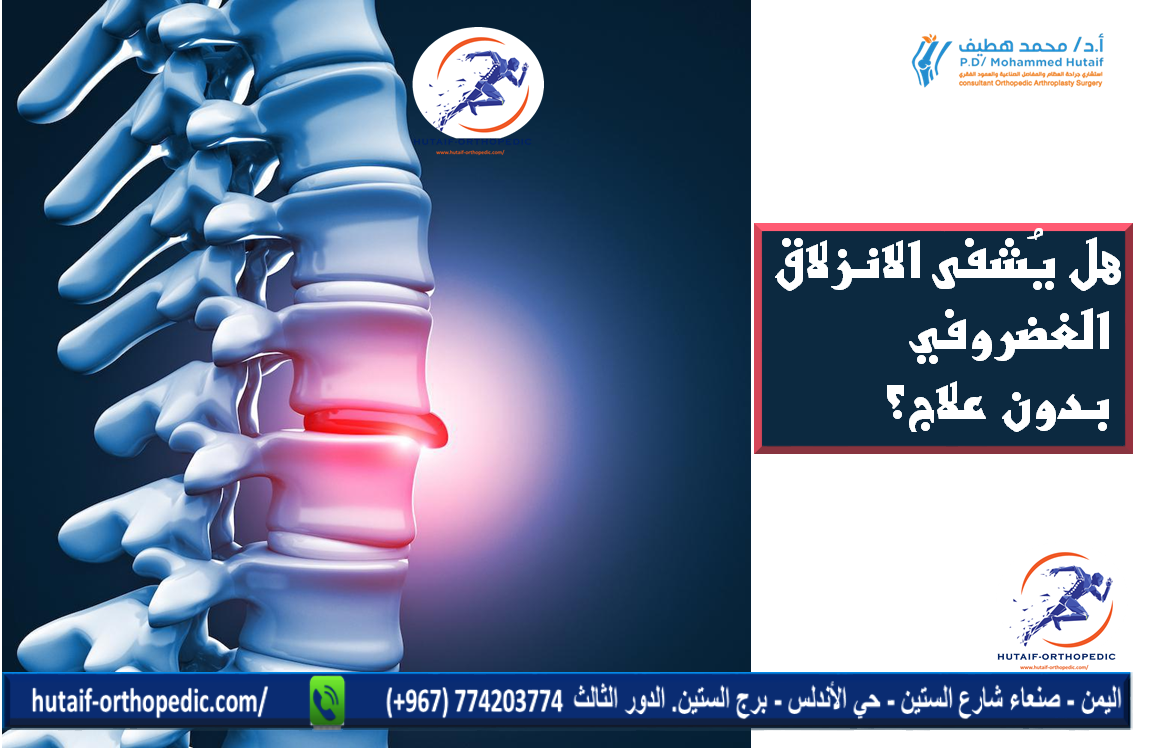 هل يُشفى الانزلاق الغضروفي بدون علاج؟