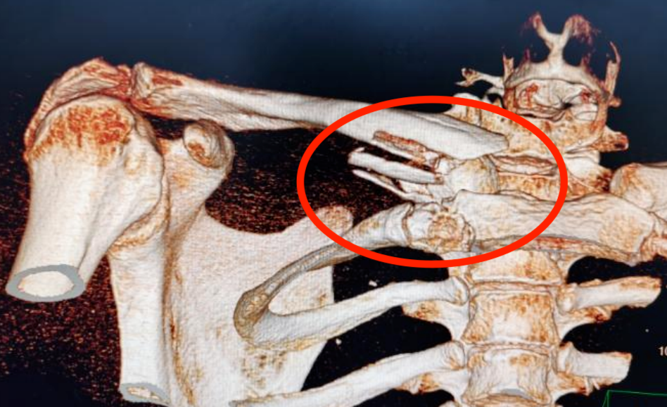 **"وداعًا لكسور عظمة الترقوة: جراحة آمنة ومضمونة!"**