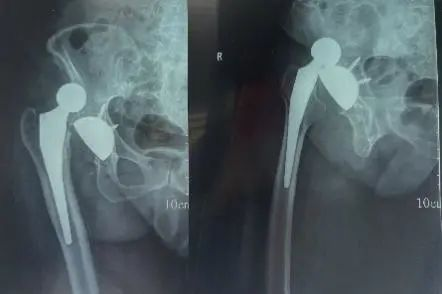 اكتشف سر نجاح تبديل مفصل الورك: الوقاية من الخلع وعلاجه!