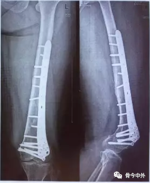 استعد عظامك: دليلك لإصلاح كسور عظم الفخذ البعيد!