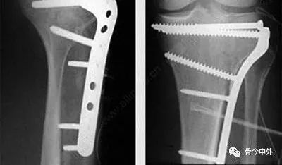 دليلك الشامل لإزالة مثبتات العظام: متى؟ كيف؟ ولماذا؟