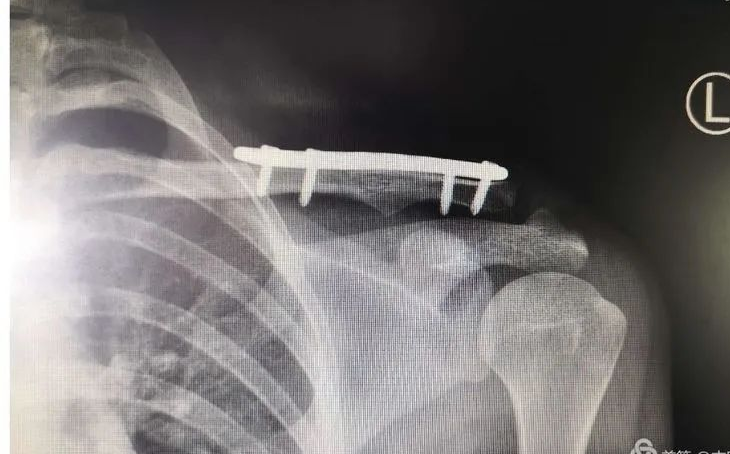 اكتشف أسرار علاج كسور الترقوة بتقنية MIPO الحديثة