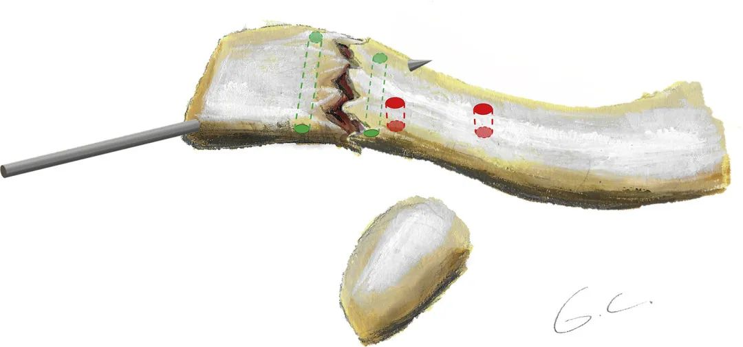 اكتشف سر علاج كسور الترقوة بدون تثبيت داخلي!