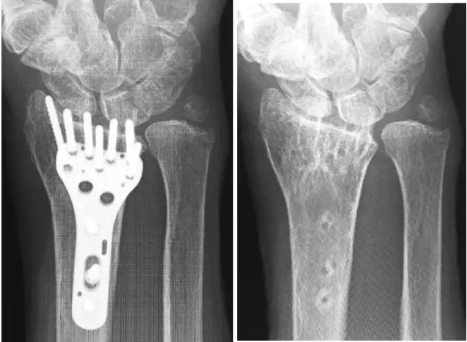دليلك الأمثل لتثبيت كسور الرسغ بتقنية الصفائح الكفية الحديثة