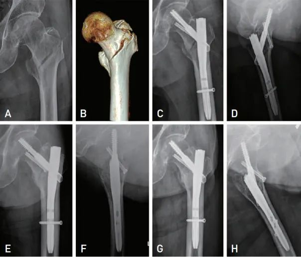 اكتشف: تقنية ثورية لعلاج كسور بين المدورين وتثبيت مثالي!
