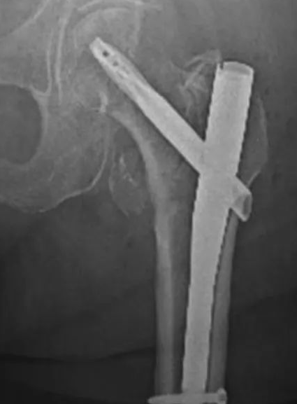 اكتشف حلول كسور العظام: ترميم ناجح بدون جراحة معقدة!