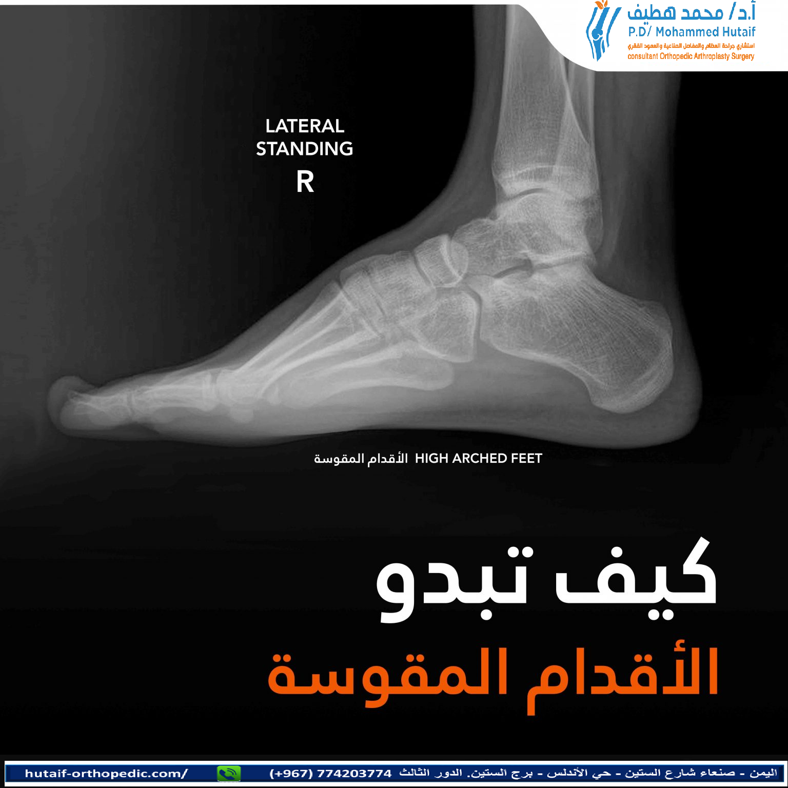 الأقدام المقوسة: المقوسة كل ما تحتاج لمعرفته لراحة قدميك