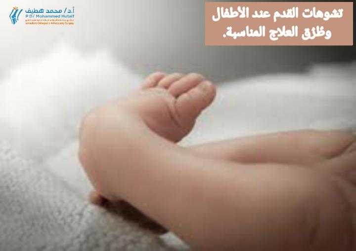 تعرّف على تشوهات القدم عند الأطفال وطُرُق العلاج المناسبة.