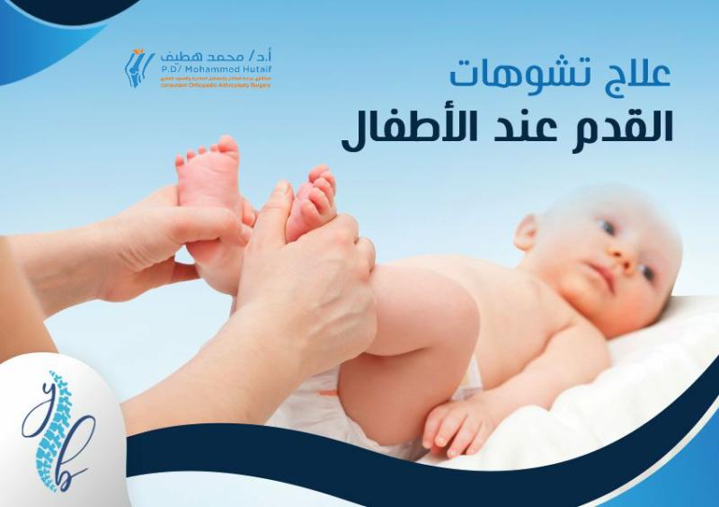 التشخيص والعلاج الفعال لتشوه حنف القدم لدى الأطفال