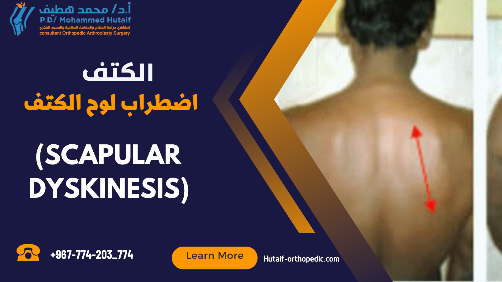 "كل ما تحتاج معرفته عن اضطرابات لوح الكتف: أسبابها، أعراضها، وطرق علاجها"