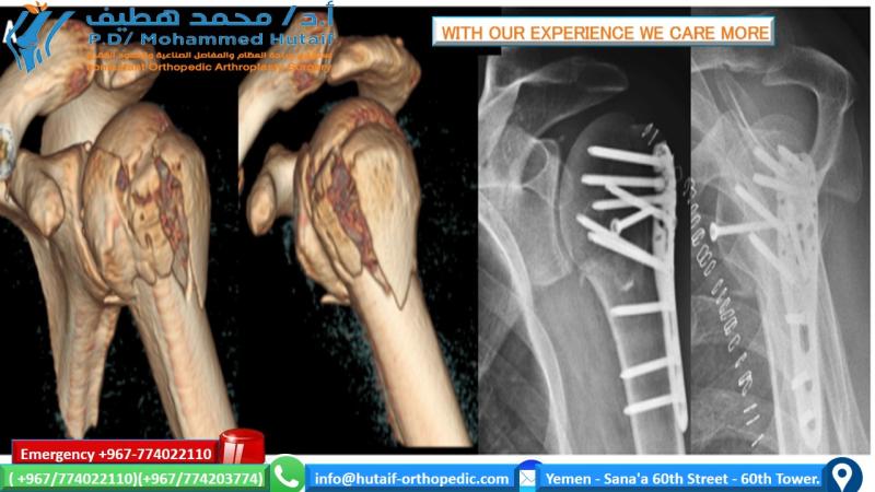 Mastering Humeral Fractures: Clinical & Radiographic Insights