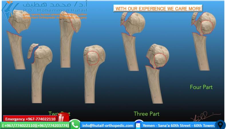 Neer Classification of Proximal Humeral fractures