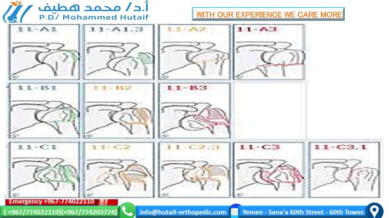 Proximal Humerus Fracture: AO Classification