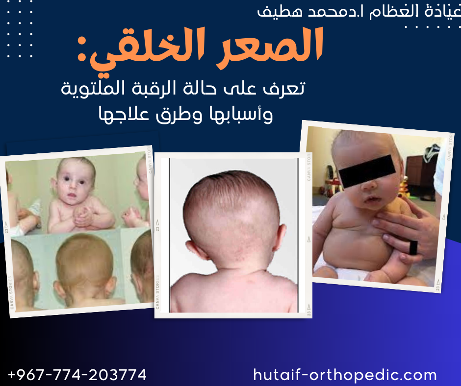 الصعر الخلقي: تعرف على حالة الرقبة الملتوية وأسبابها وطرق علاجها