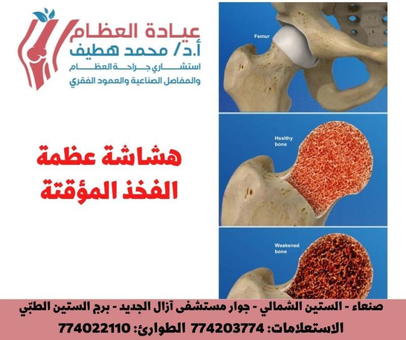 فهم هشاشة العظام  المؤقتة في الورك: الأعراض والأسباب والعلاج ( Transient Hip Osteoporosis)