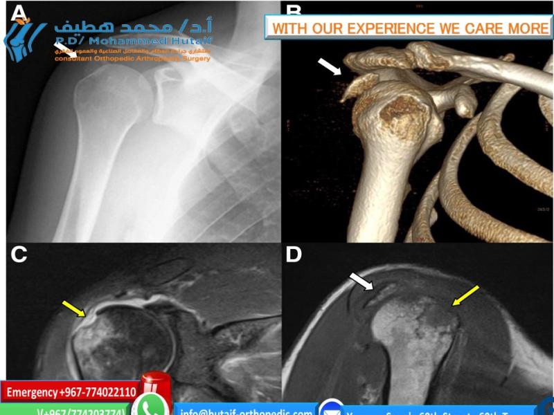 FOR DOCTORS PROXIMAL HUMERAL FRACTURES Extraarticular 2-Part, Greater Tuberosity, Displaced Treatment Screw fixation