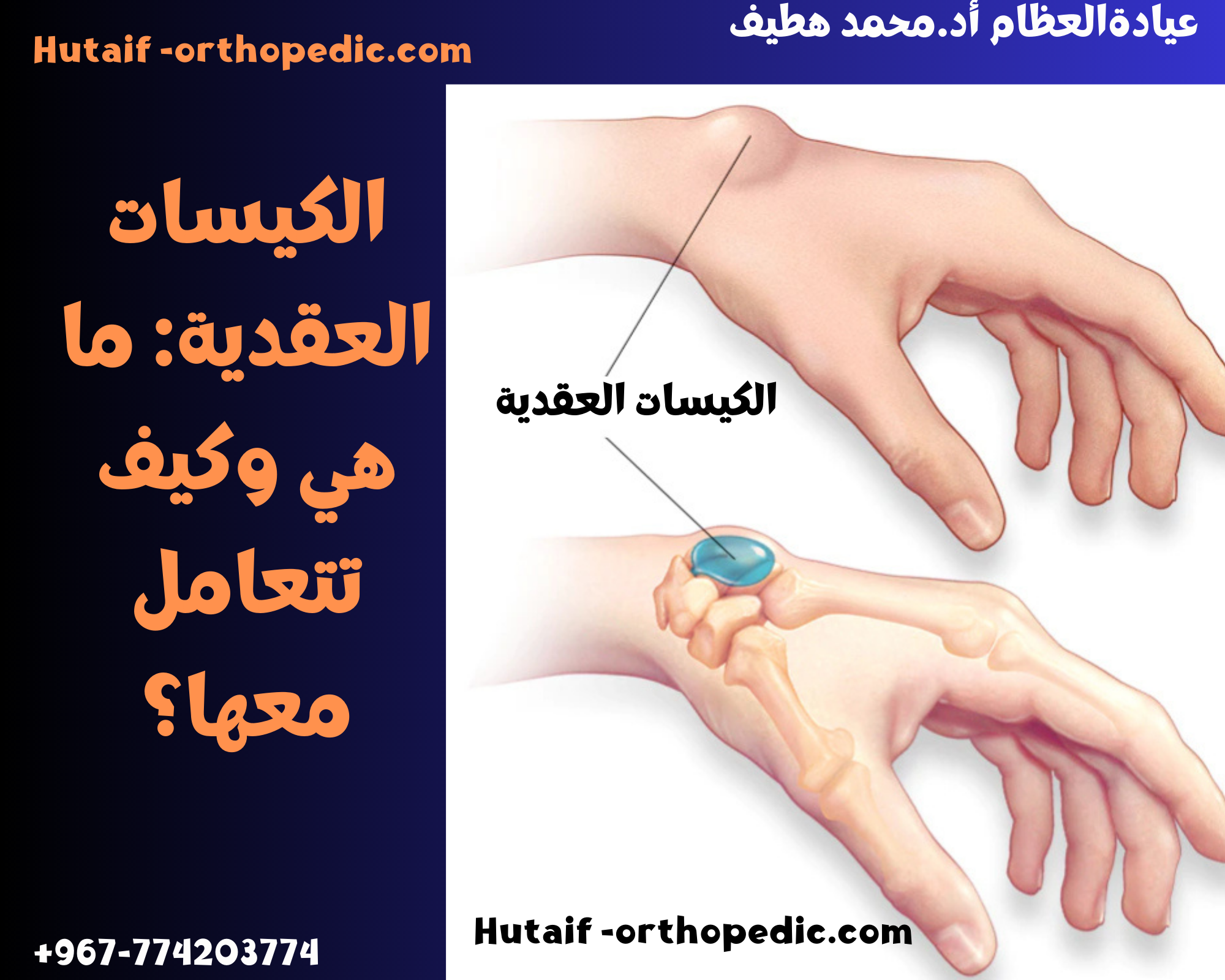 الكيسات العقدية: ما هي وكيف تتعامل معها؟