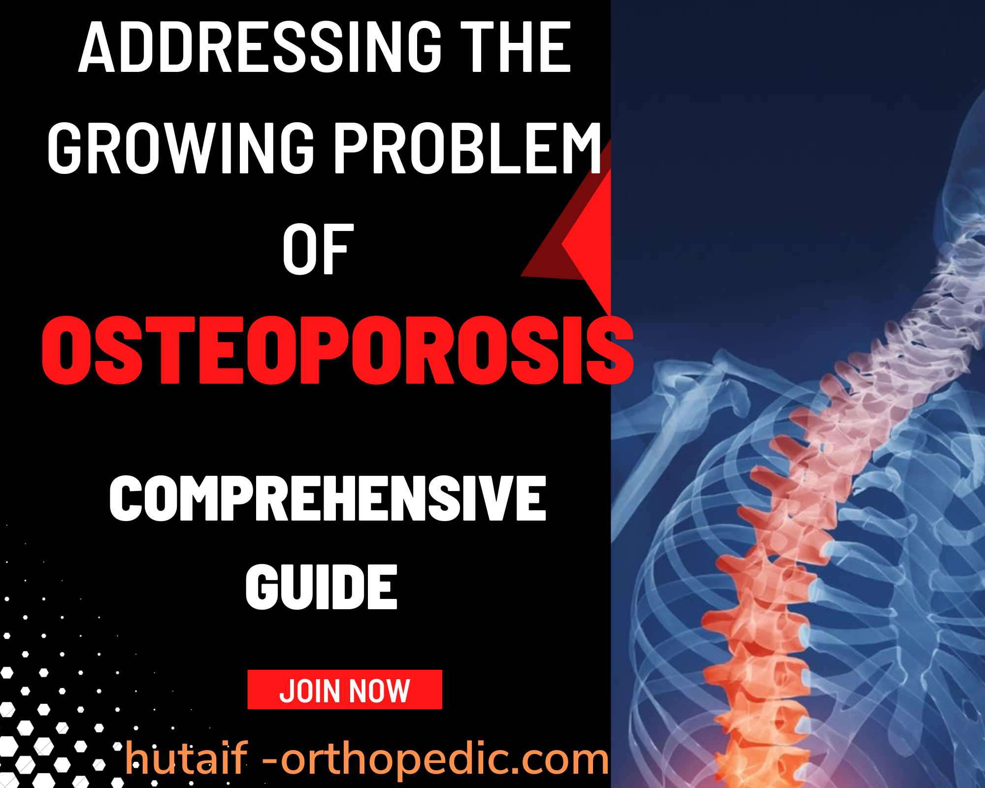 حارب هشاشة العظام: دليلك الشامل لعظام أقوى!