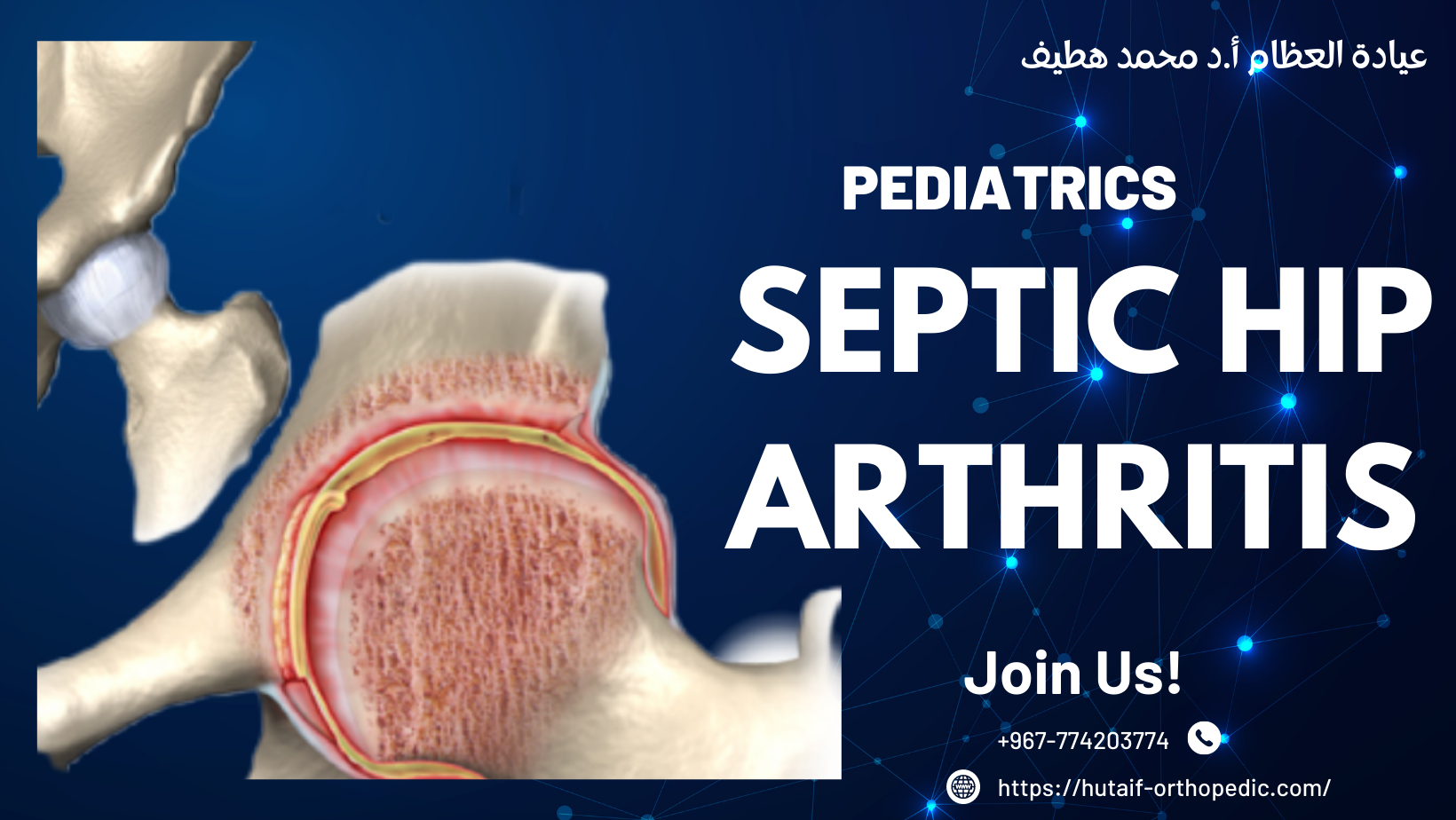 اكتشف: التهاب مفصل الورك الإنتاني عند الأطفال - دليلك الشامل!