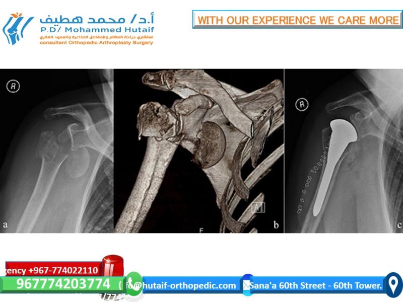 For Doctors Proximal Humeral Fractures, Extra Articular 2-Part, Surgical Neck, Impaction Treatment Reverse Arthroplasty Main indications