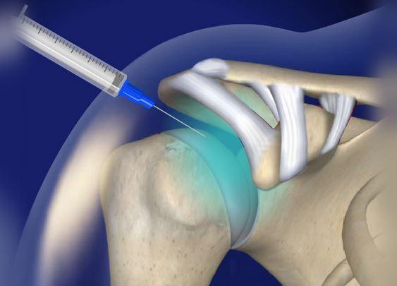 حقن الكتف الموجهة بالموجات فوق الصوتية: علاج فعال وآمن لآلام الكتف