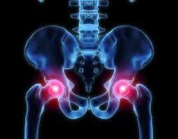 أعراض التهاب مفصل الورك وطرق علاجه - دليل شامل