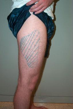 كل ما تحتاج معرفته عن متلازمة الورك المُشقّق: الأسباب، الأعراض، وطرق العلاج