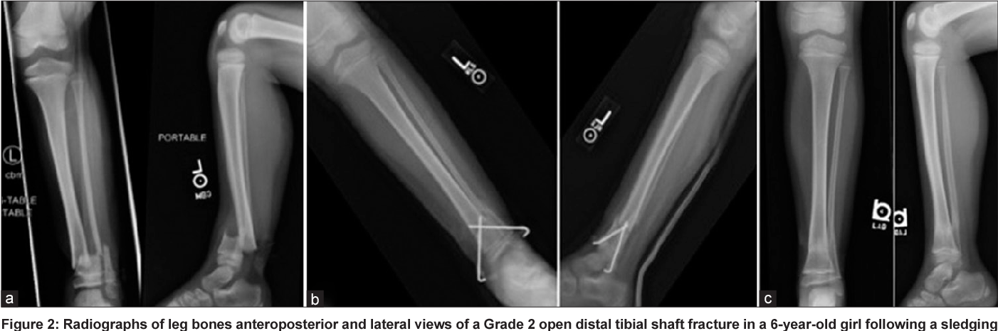 كسور وخلوع الكاحل والقدم عند الأطفال: أسبابها وعلاجها