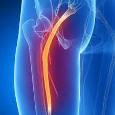 اكتشف: أسباب، أعراض، وعلاج اعتلال الجذور العصبية