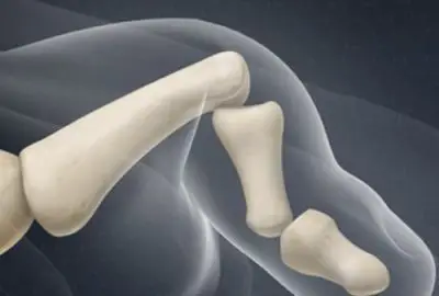 ما هو أصبع القدم المطرقية وكيف يمكنك التعامل معه؟