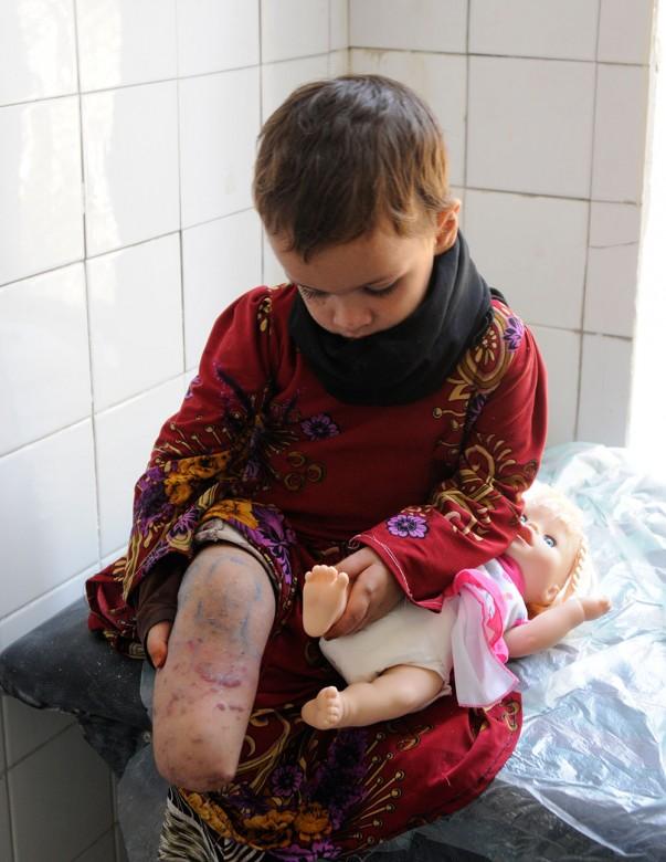 ساهم معنا: علاج العظام أمل لمرضى اليمن المحتاجين