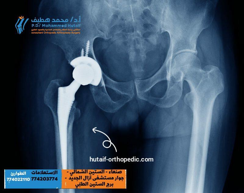 تخلص من خشونة مفصل الورك (الحوض) في أسرع وقت