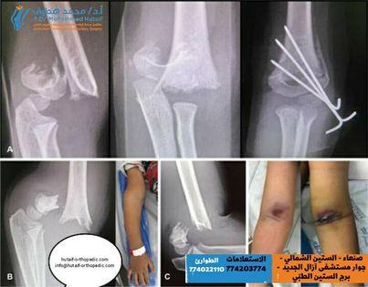 Supracondylar Humerus Fracture
