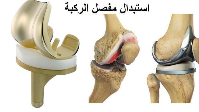 هل مفصل الركبة الصناعي هو الحل النهائي لمشاكل الركبة؟