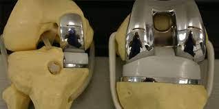 التقنيات المستخدمة في تصنيع وزراعة مفصل الركبة الصناعي