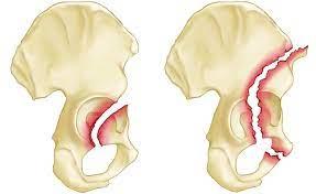 كسور حوض الكأس: التشخيص والعلاج والتوقعات