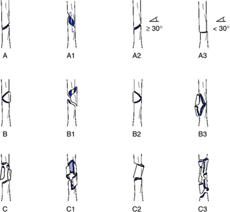 اكتشف: كسور عظم الفخذ - تشخيص وعلاج فعال!