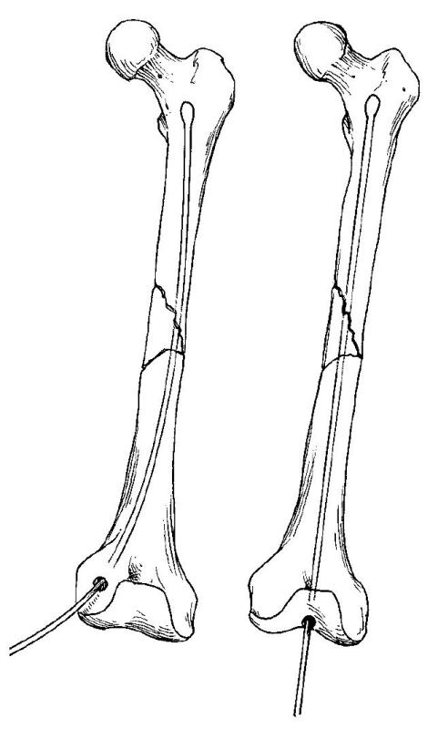 فهم كسور قشرة الفخذ: التشريح ، التشخيص ، والعلاج