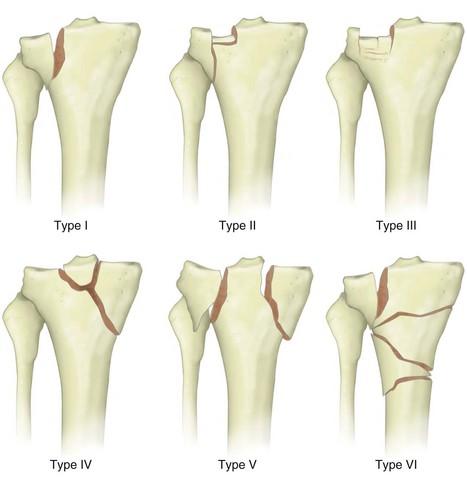 كسور سطح العظمة الأولية في الظنبوب: التشريح والتشخيص