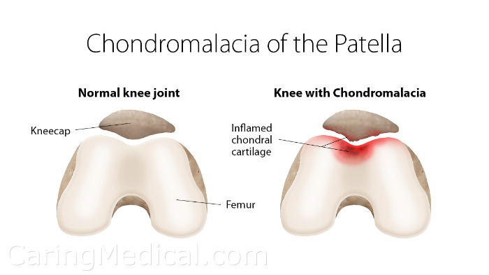 تلين عظمة الرضفة: إدارة آلام الركبة الخاصة بك