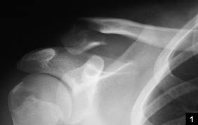 اكتشف كسور عظمة الترقوة البعيدة: تشخيص وعلاج ومضاعفات